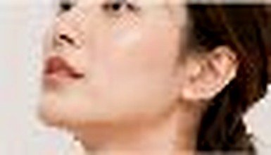 Endoscopic Brow Lift