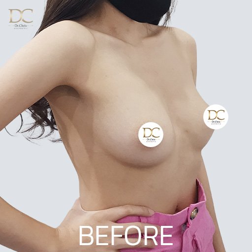 Before/After
