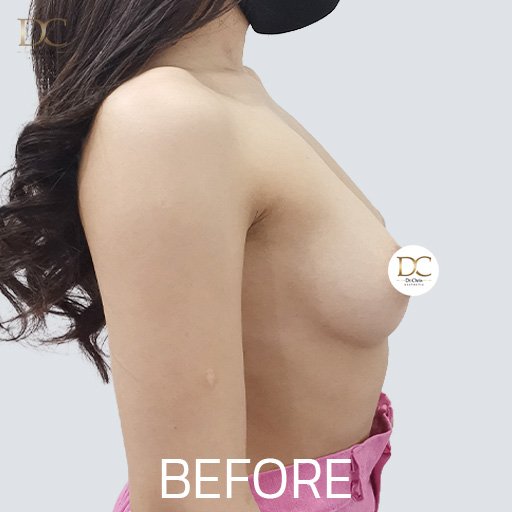 Before/After