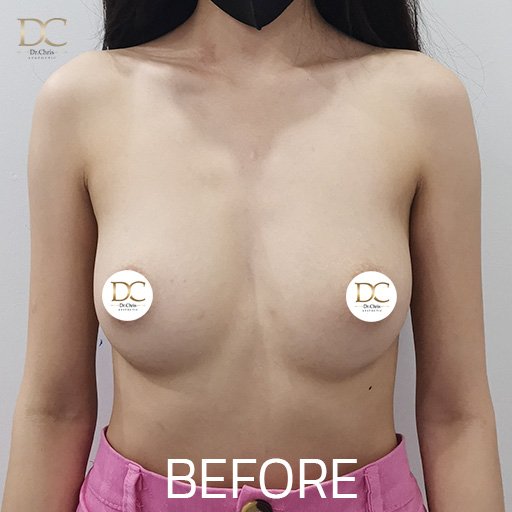 Before/After
