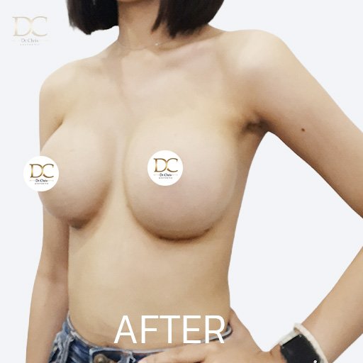 Before/After
