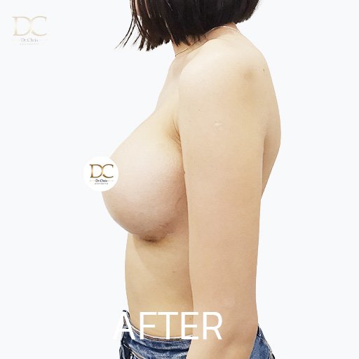 Before/After