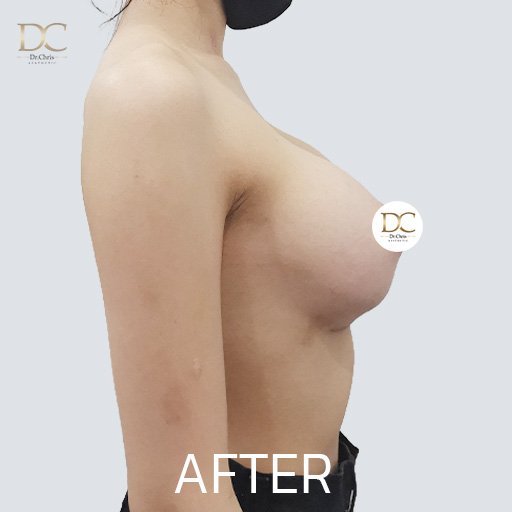 Before/After