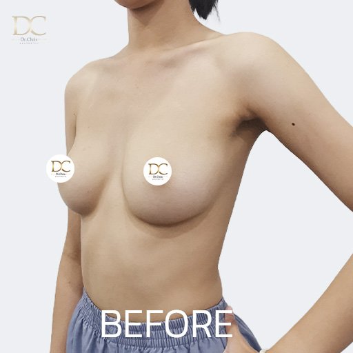 Before/After