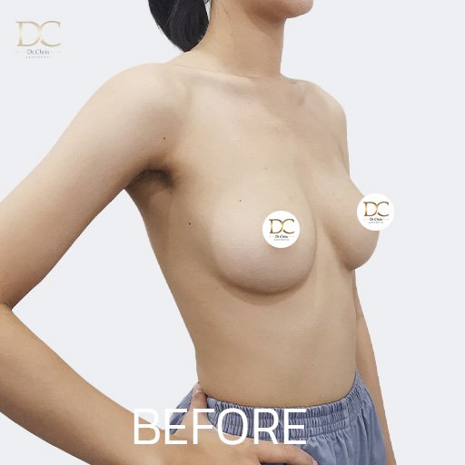 Before/After