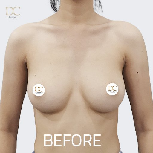 Before/After
