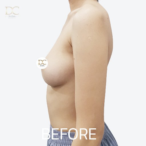 Before/After