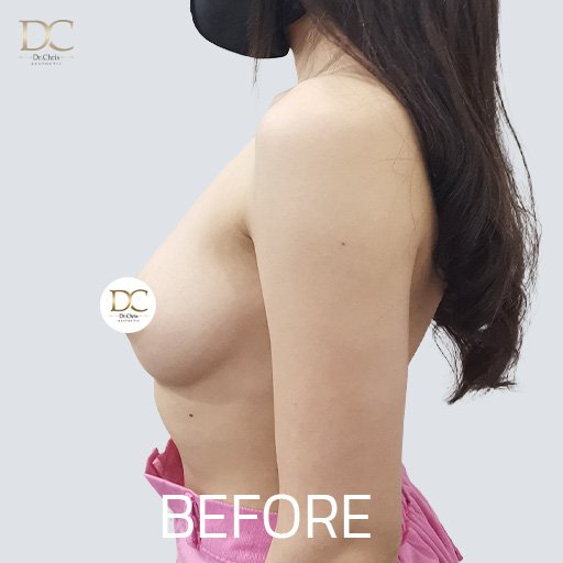 Before/After
