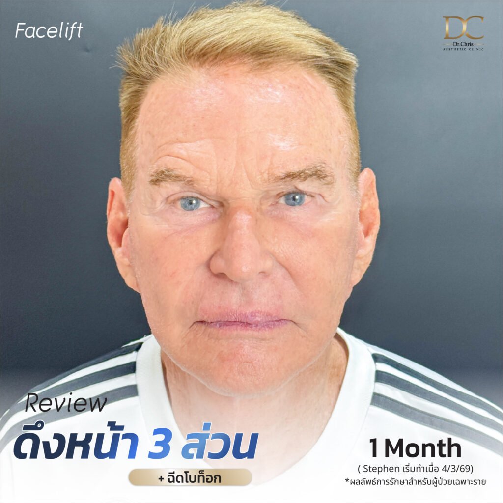Before/After