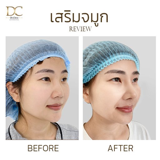 เสริมจมูก
