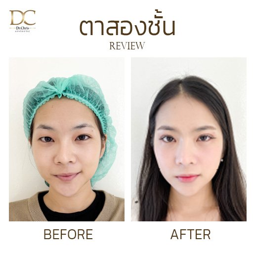 ทำตาสองชั้น + ตกแต่งหนังตา