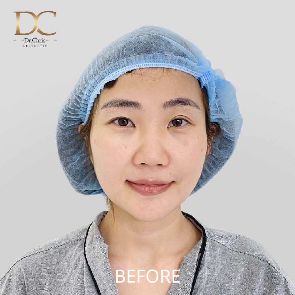 Before/After