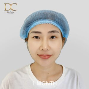 เสริมจมูก — หลัง