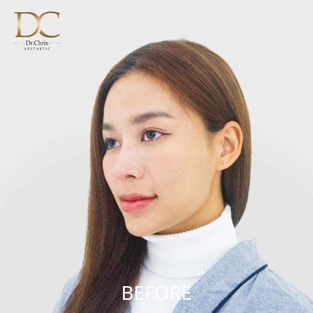 Before/After