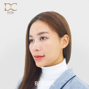 ทำตาสองชั้น — ก่อน