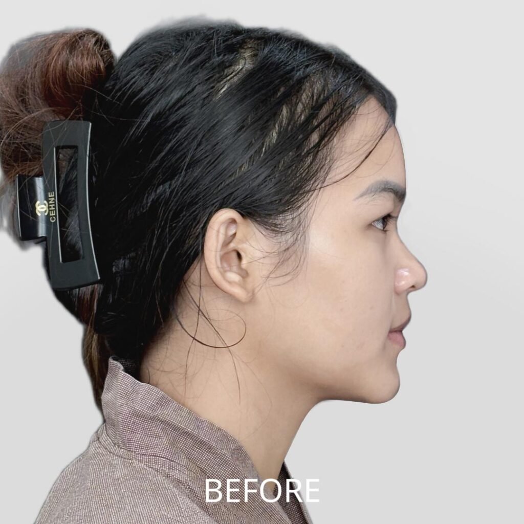 Before/After