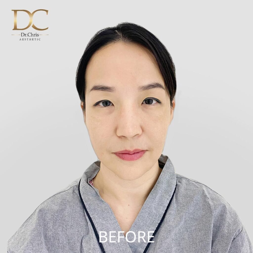 Before/After