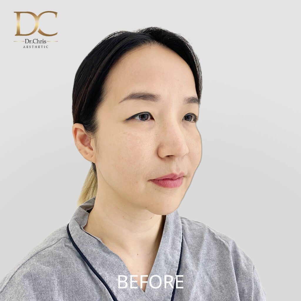 Before/After