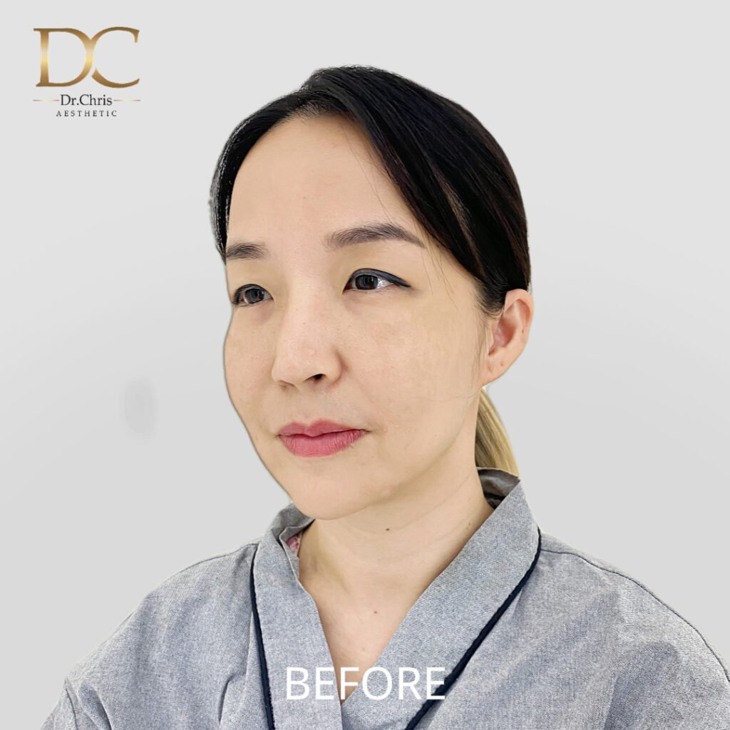 Before/After