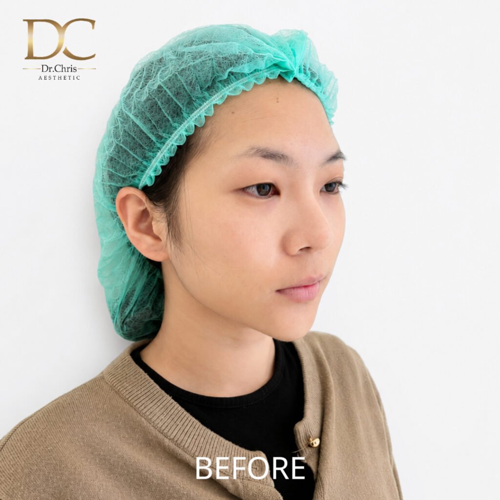 Before/After