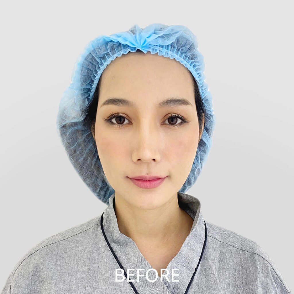 Before/After