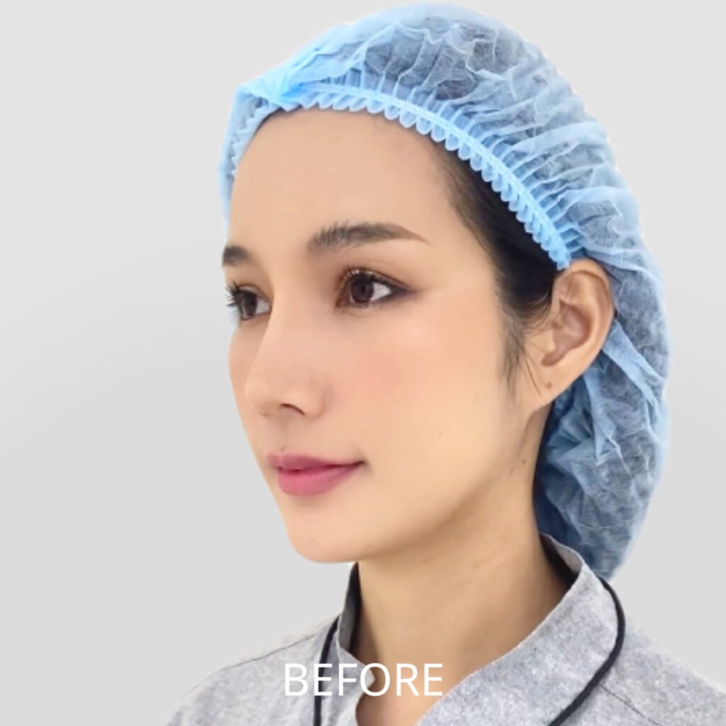 Before/After