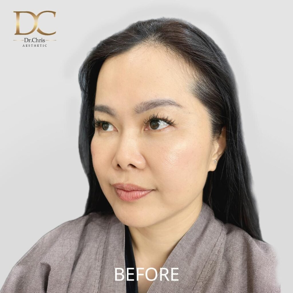 Before/After