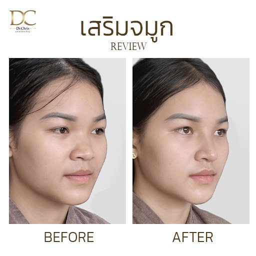 เสริมจมูก