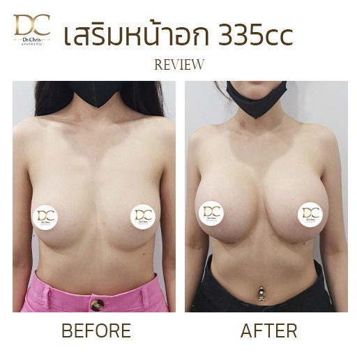 เสริมหน้าอก 335cc