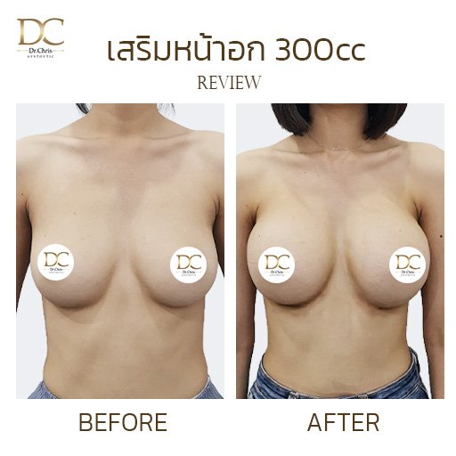 เสริมหน้าอก 300cc